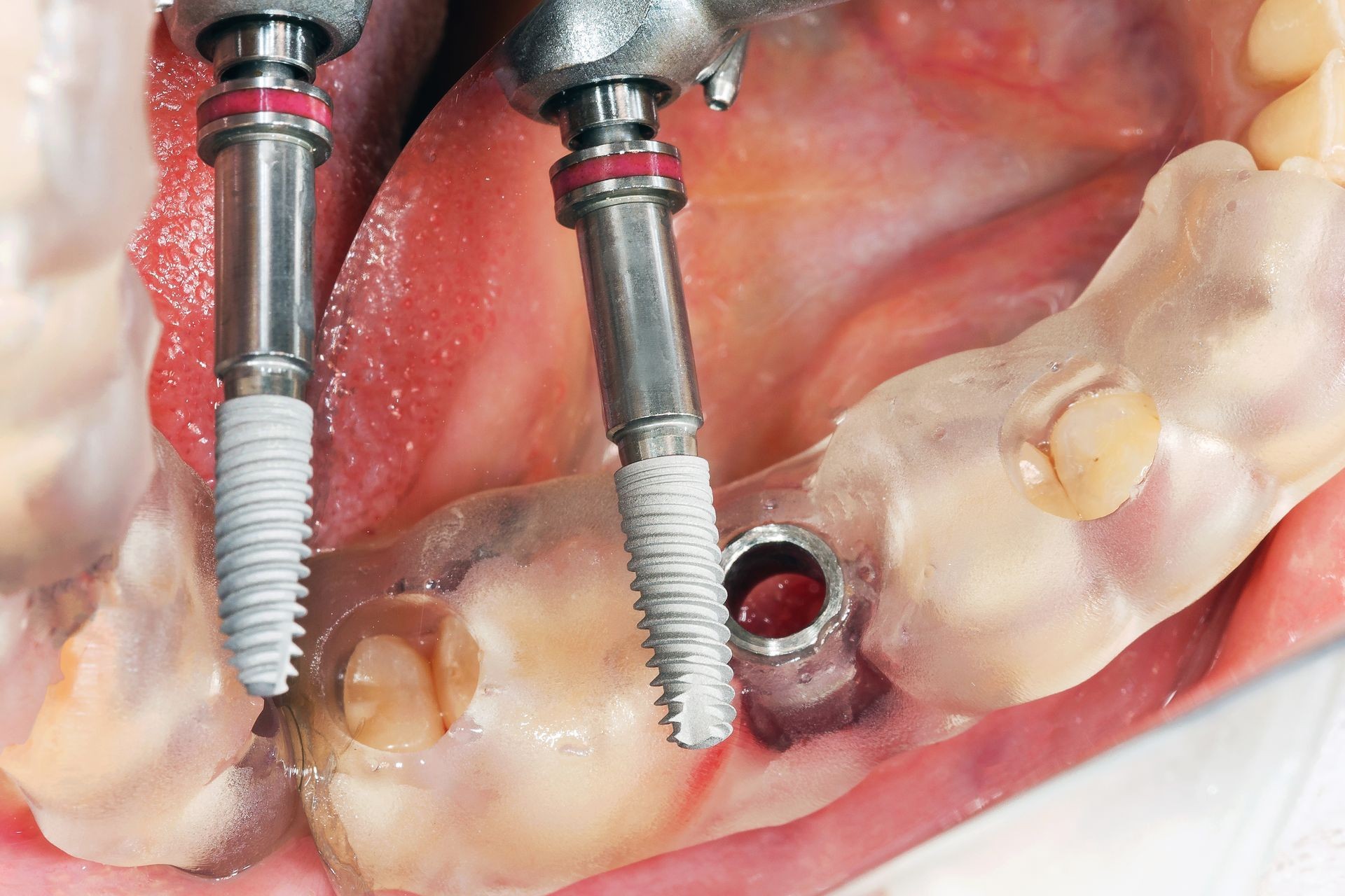 dental implant for implantation using a special template during the operation